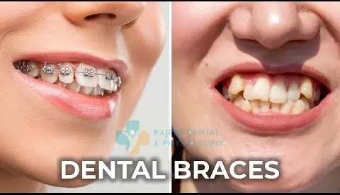 Examples of dental braces and tooth alignment