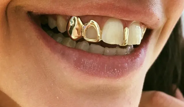 Gold-coloured decorative dental grillz over front teeth