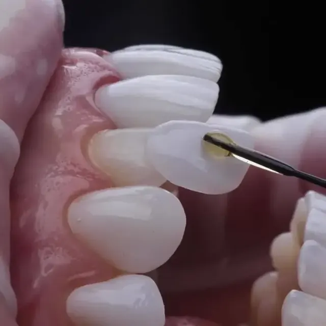 Illustration of a dental veneer being fitted to a front tooth