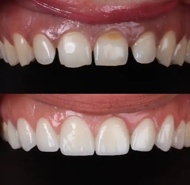 Example showing changes in tooth shape and spacing