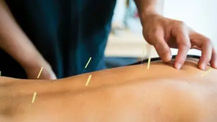Acupuncture services at RDPC Karachi