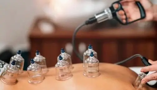 Cupping therapy at RDPC Karachi