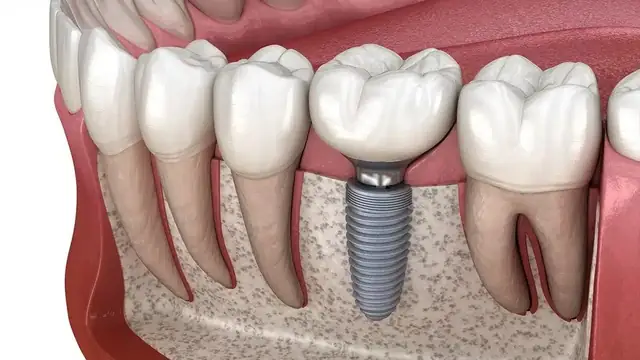 Dental implants at RDPC Karachi