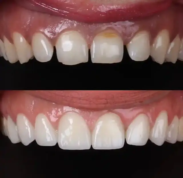 Smile makeover cosmetic dentistry