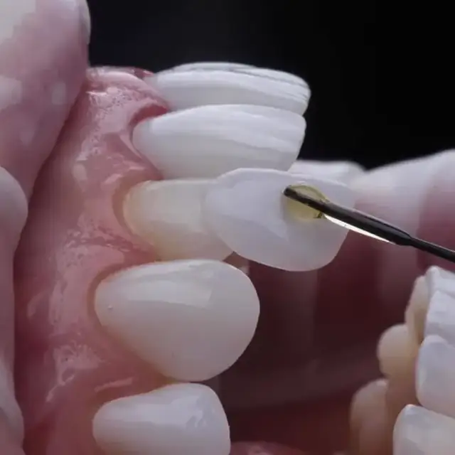 Dental veneers and cosmetic smile treatment in DHA Karachi