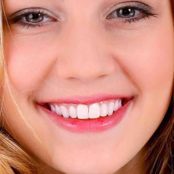teeth whitening