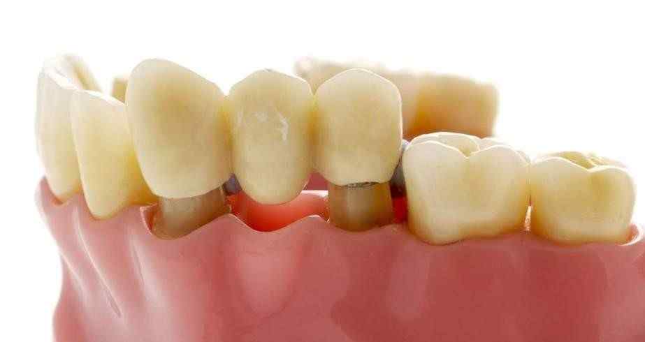 Dental Bridges