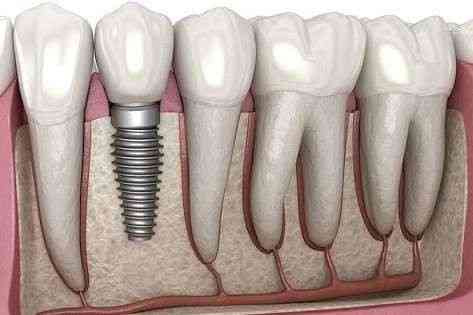 Dental Implants