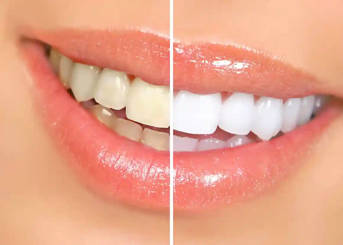 Teeth whitening treatment in Karachi