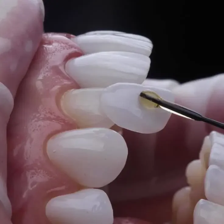 Dental veneers and cosmetic smile treatment in DHA Karachi